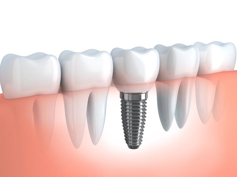 Dental Implants Collinsville, IL 